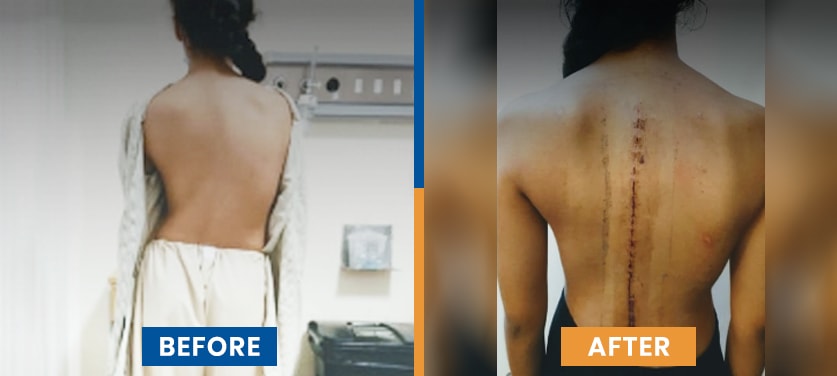Scoliosis and Spine Surgery Before After